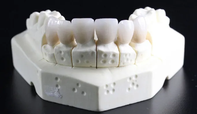 braces in dubai price