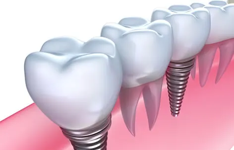 invisalign dubai cost