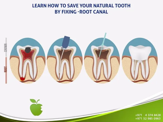 Dental Sealants service in Dubai