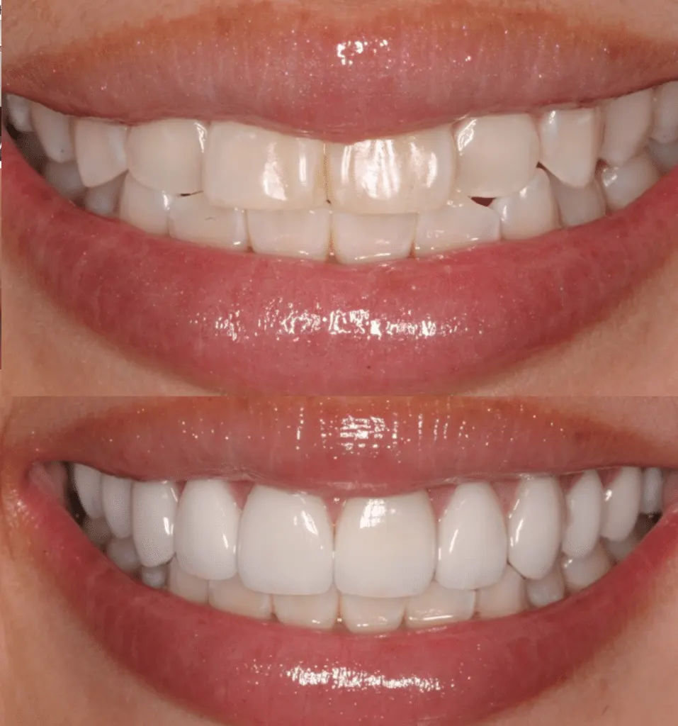 Veneers In Dubai