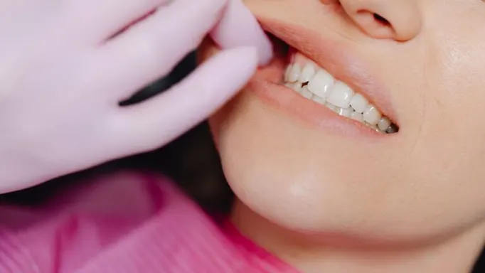 Partially impacted wisdom tooth