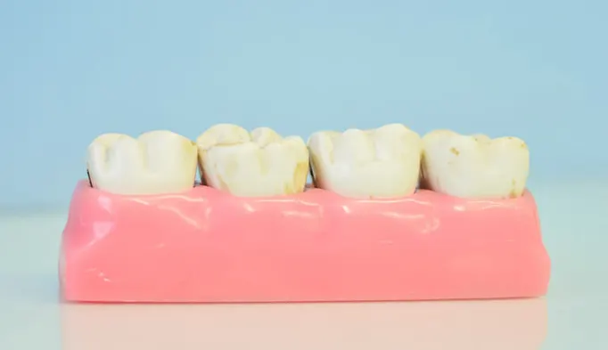 dental implants in dubai