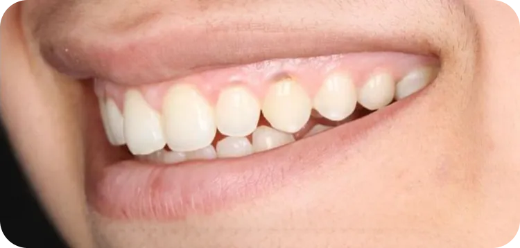 Before: Minimal gum contouring along with 10 veneers