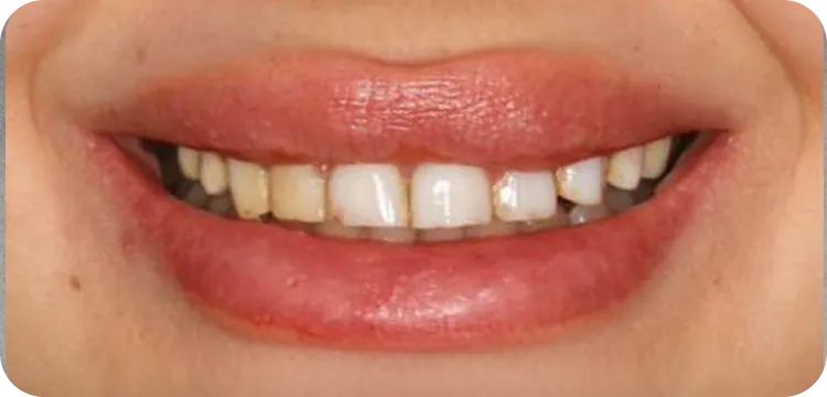 Before: Veneers treatment