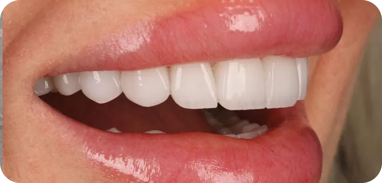After: Veneers treatment