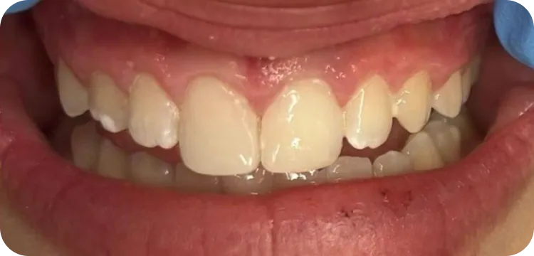 After: Composite restoration