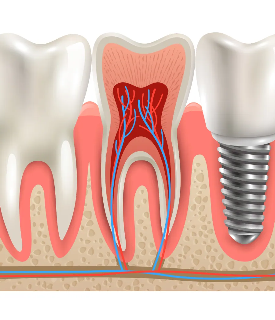 Illustration of a gum graft