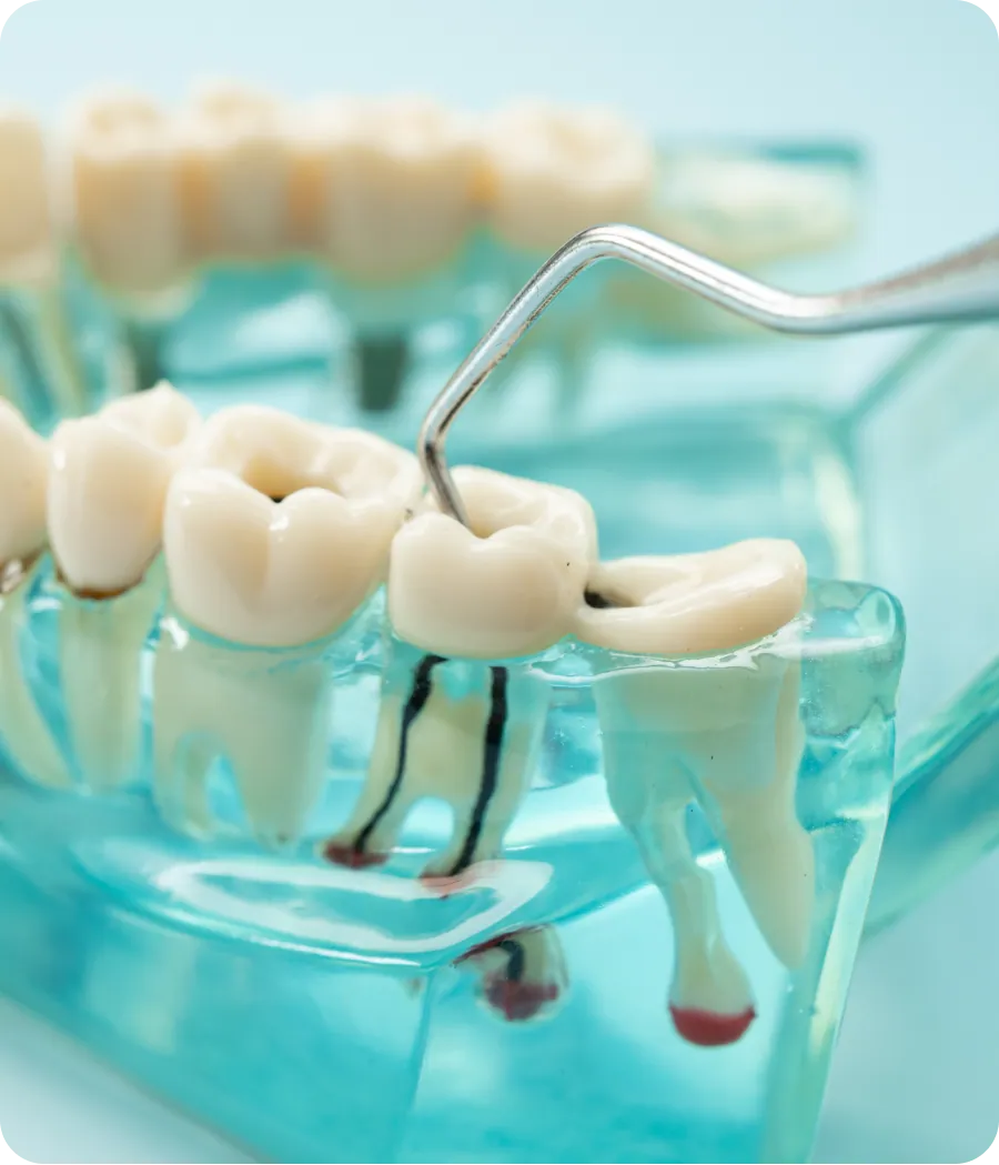 Dentist fitting a resin inlay