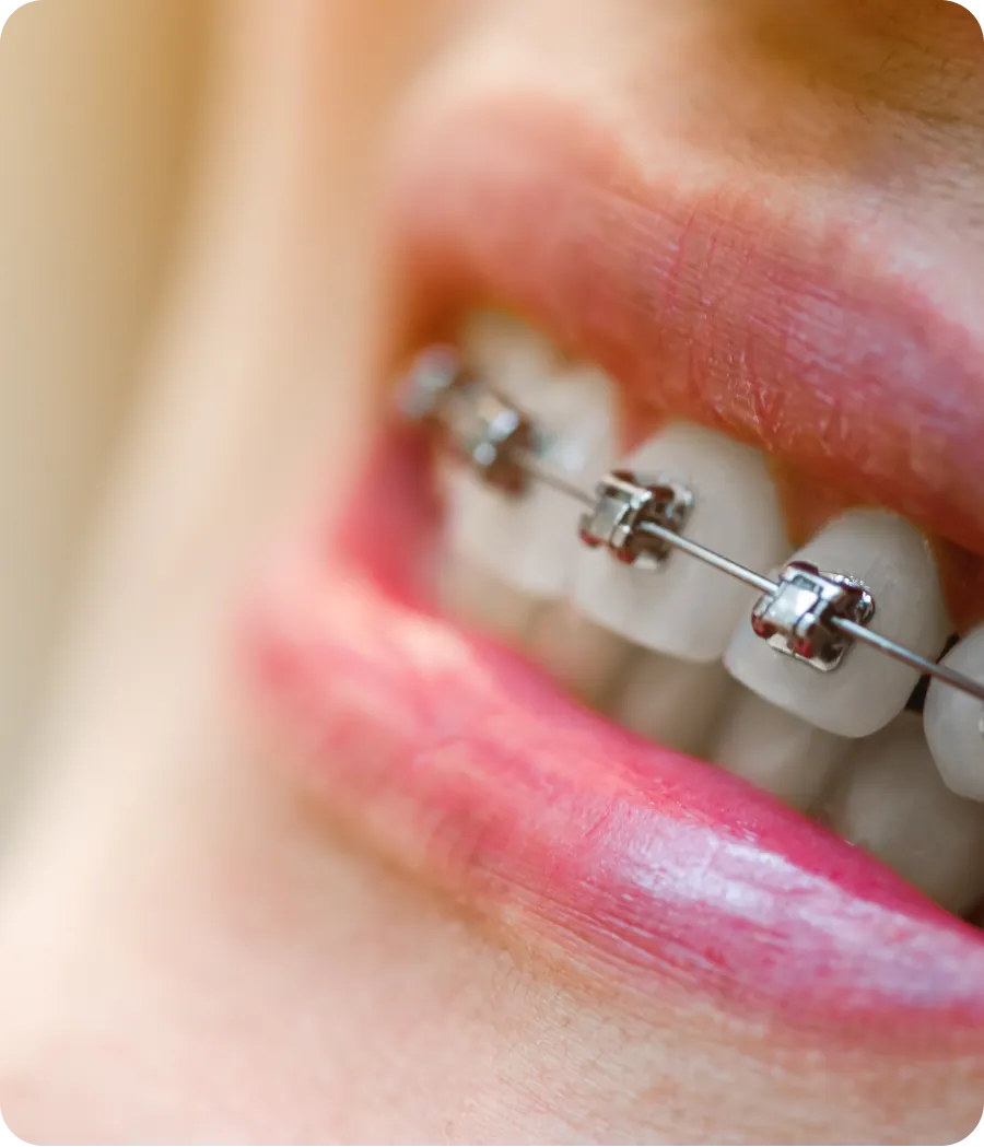 Metal braces on a patient's teeth
