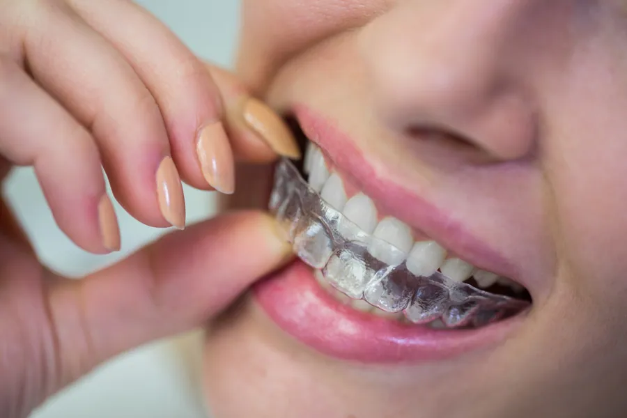 Clear aligner trays