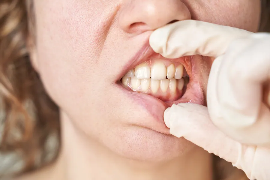 Dentist explaining gum health to a patient