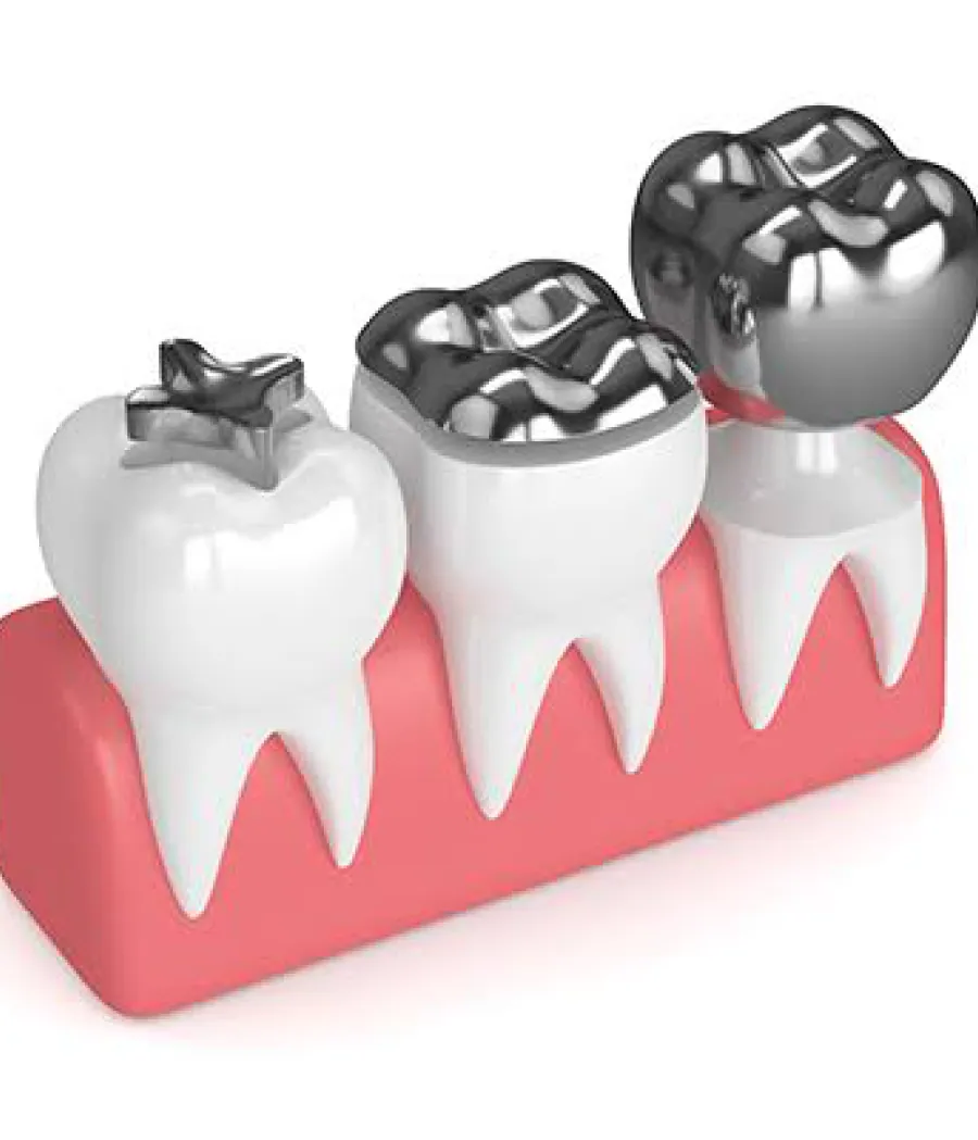 Porcelain onlay on a molar model