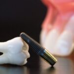 Dental Implant: The Best Option to restore your Missing Teeth