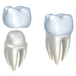 Repair Your Smile With Dental Crowns