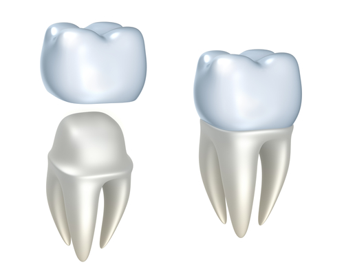 dental implants in dubai cost