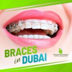 Where is the best place to get braces in Dubai