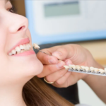 How Much do Veneers Cost? What You Need to Know