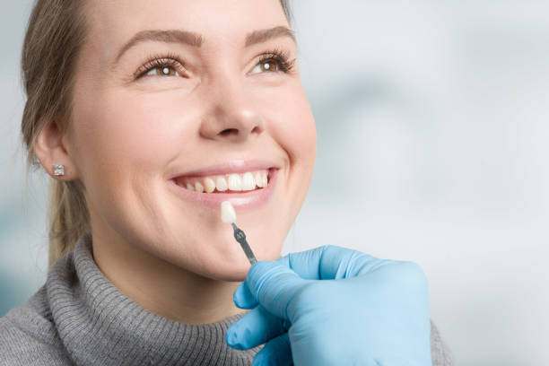 Using shade guide at mouth of a woman to check veneer of tooth