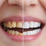 Quick Guide to Oral Surgery Treatments for a Smile Makeover