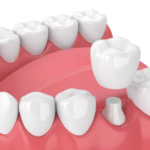 When Is a Dental Crown Recommended?