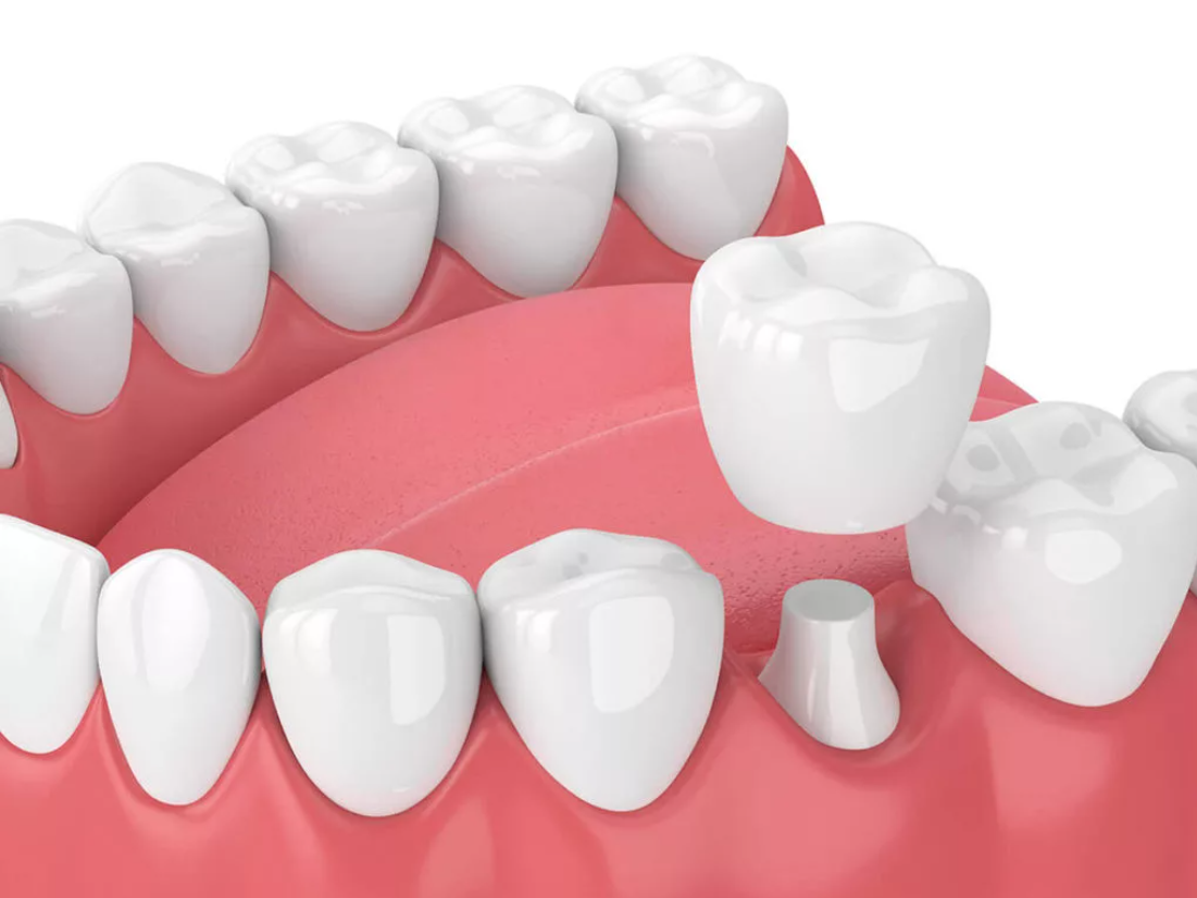 When Is a Dental Crown Recommended?