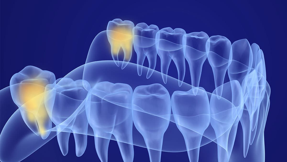 Wisdom Teeth Removal (Extraction): What to Expect, Recovery and Pain