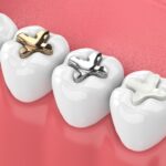 4 types of dental fillings: How to know which one you should choose?