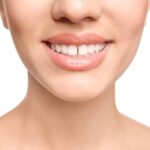 Can Dental Veneers Fix a Gap Between Teeth?