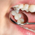 The Importance of Dental Sealants for Preventing Tooth Decay