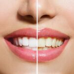 Teeth Whitening Options:  Comparing Home Teeth Whitening, Laser Teeth Whitening, and Zoom Teeth Whitening